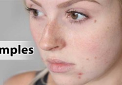 home remedies for Pimple